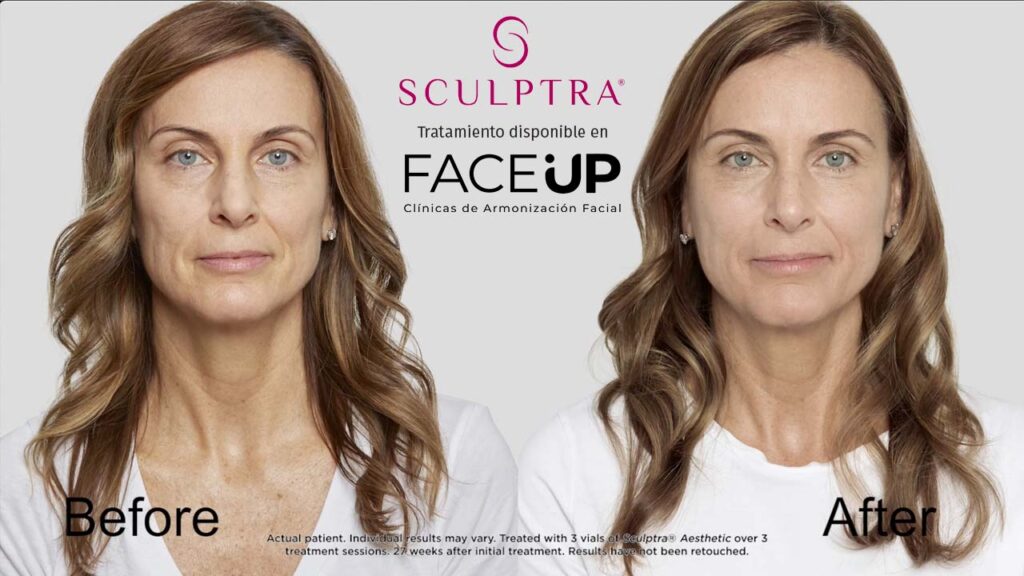 Descubre C Mo El Sculptra Facial Puede Rejuvenecer Y Transformar Tu