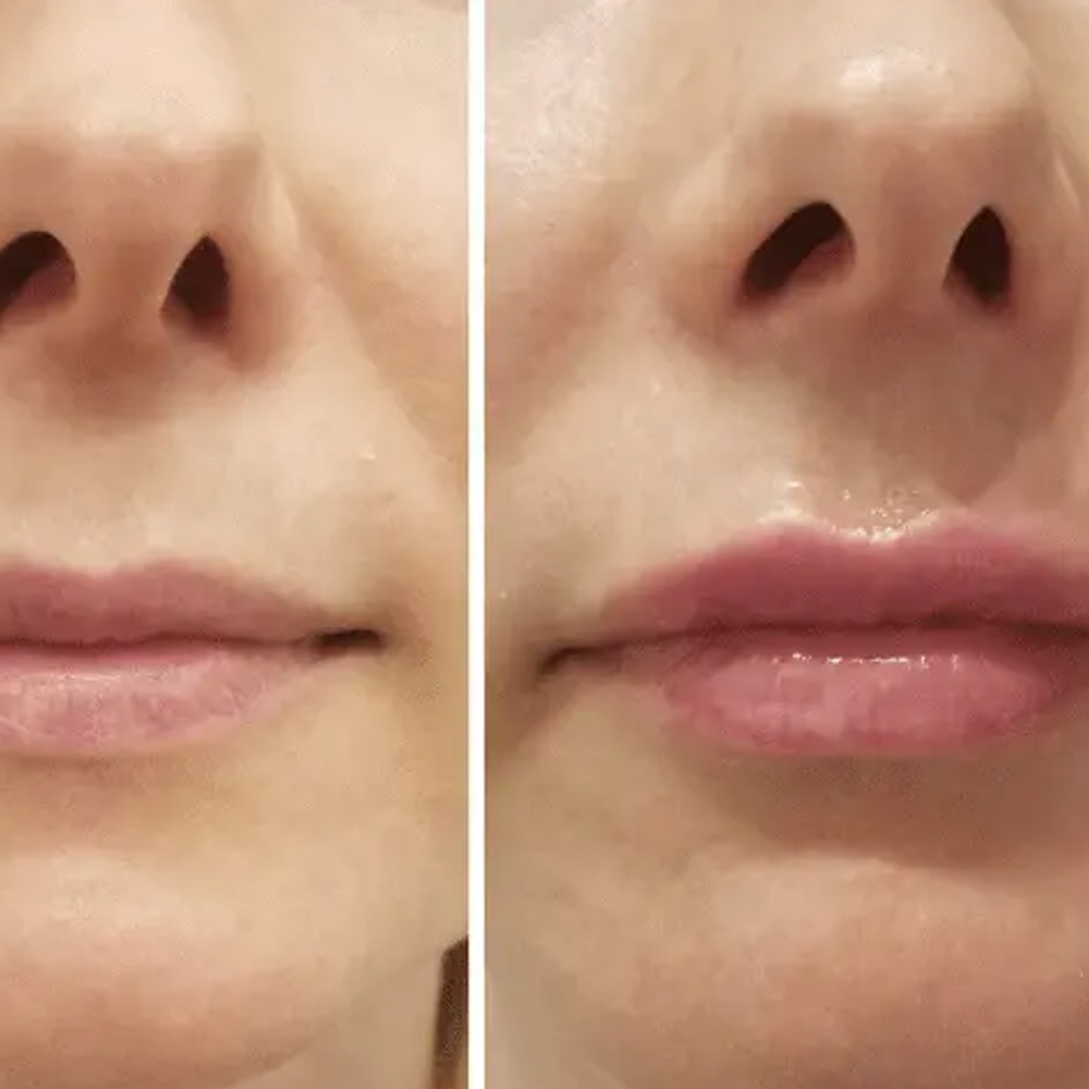 Lip Flip con Botox